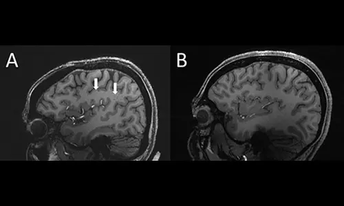 The arrows show enlarged perivascular spaces in the brain of a chronic migraine patient (left) compared to a healthy control (right). (Radiological Society of North America)