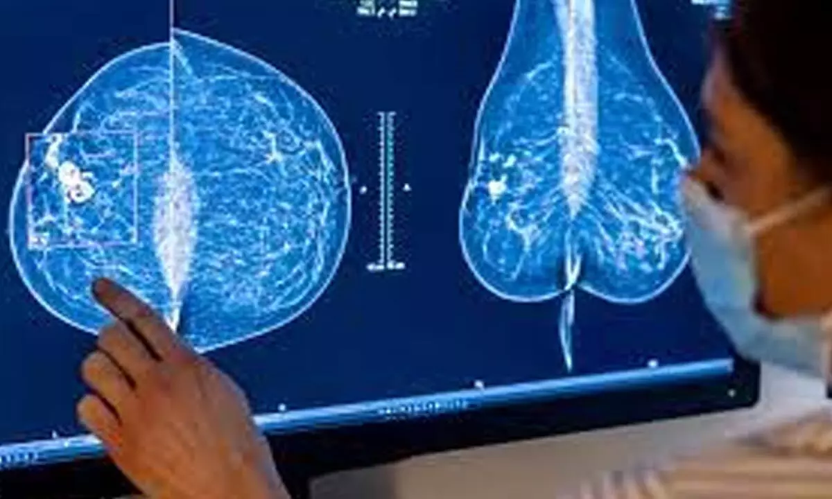 Google licensed its AI research model for breast cancer screening to iCAD