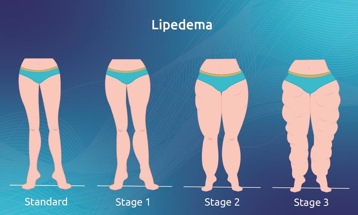 Lipedema – a neglected fat disorder