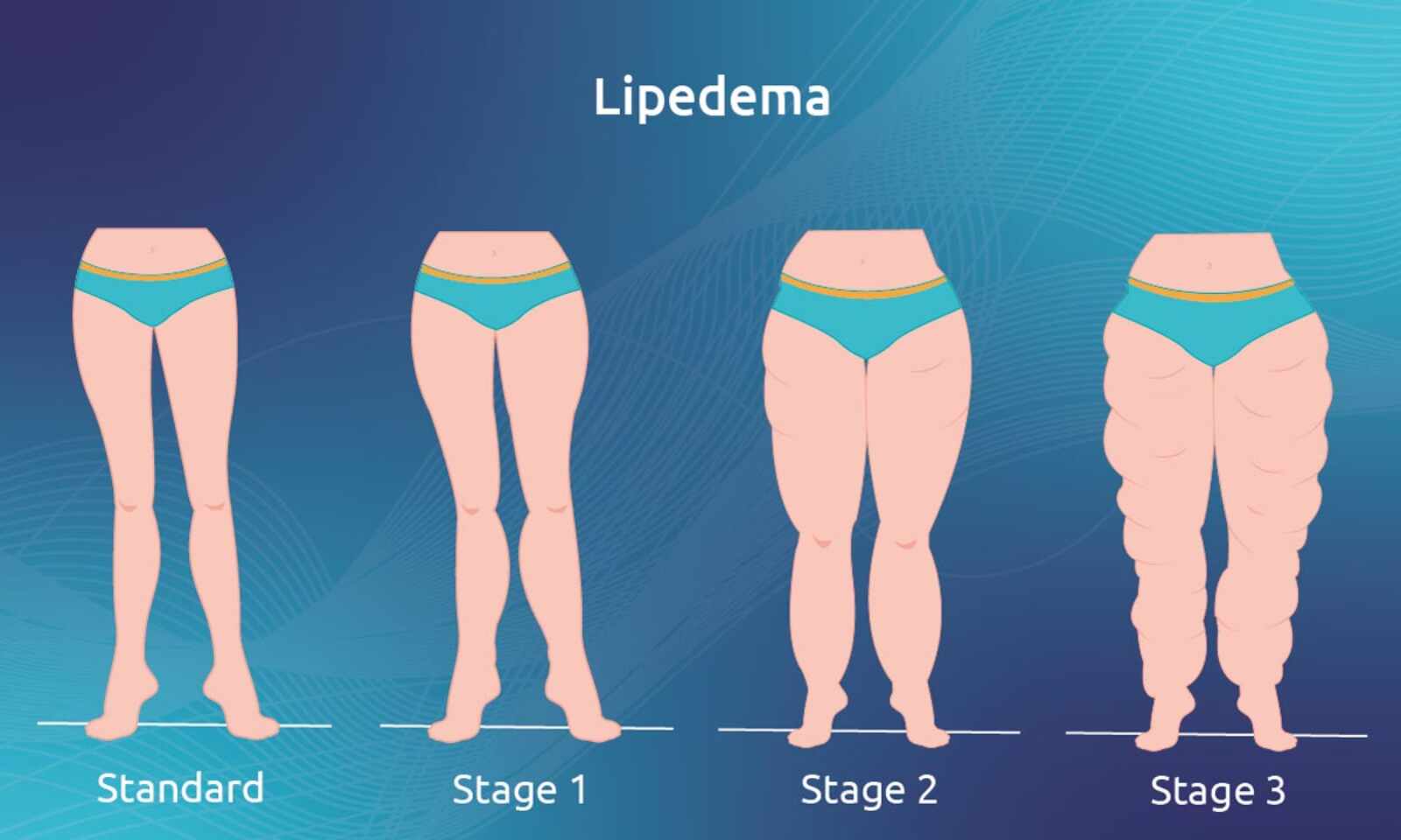 Is It Lipedema or Just Fat? Understanding Lipedema and Its Stages