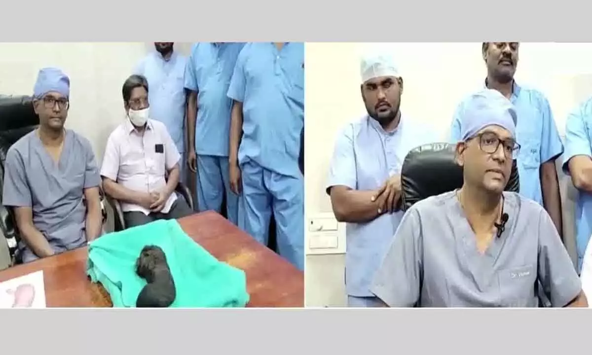 Andhra Pradesh: 1kg hairball removed from girls stomach in Gudivada