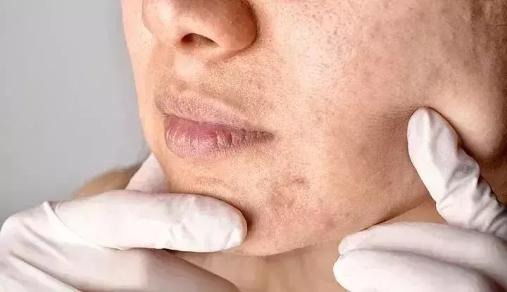 How To Handle With Clogged Pores During Winter