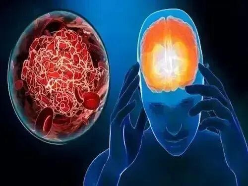 how-do-natural-remedies-help-patients-with-brain-strokes