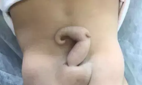 Doctors found a soft tissue tail forming where the spine and pelvis meet.