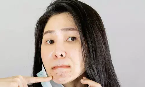 How to prevent ‘maskne’ with the covid scare on the rise?