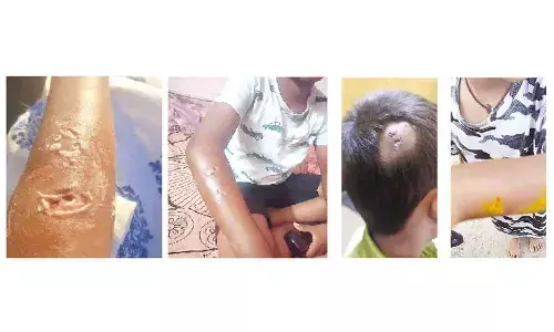 Canine terror strikes Rajendranagar: Marauding Dogs Attack 5