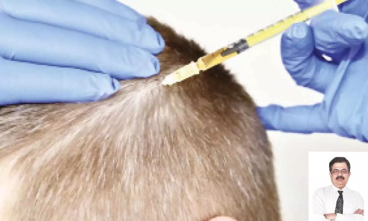 Mesotherapy:  A safe, non-surgical procedure to address hair loss