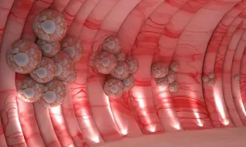 Colorectal cancer: Gurugram hospital exhibits a 3D walkthrough colon