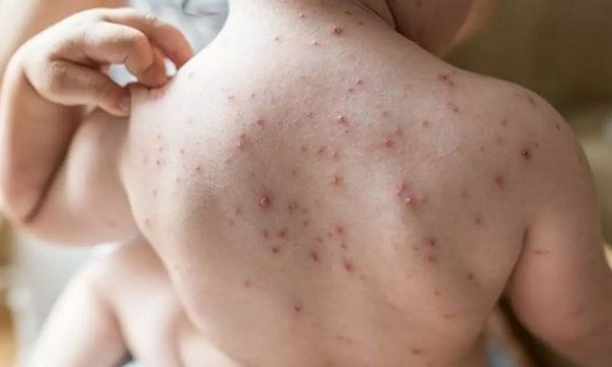 Chicken Pox - myths and realities