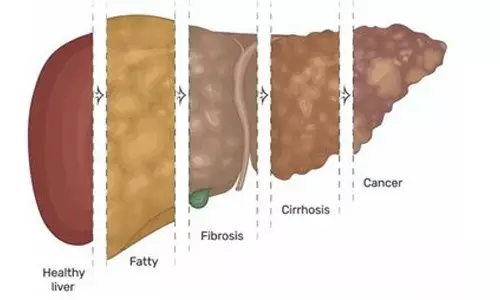 let your liver live long