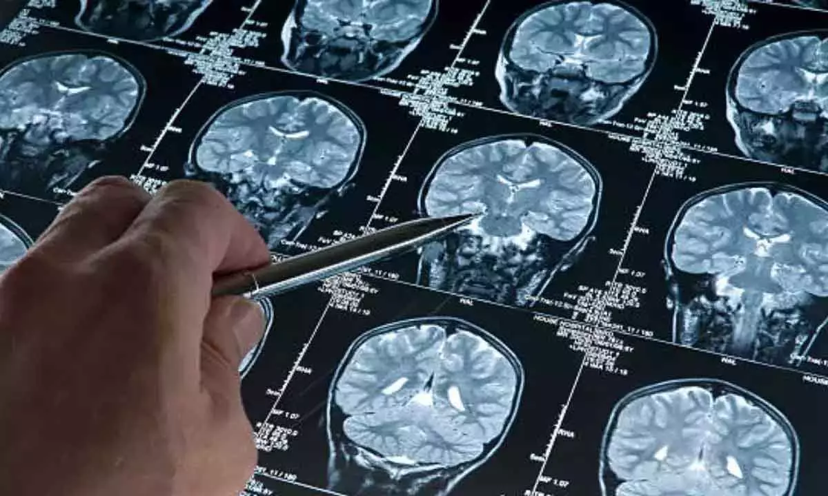 Brain tumour cases rising steadily in India, 20% are children: Doctors