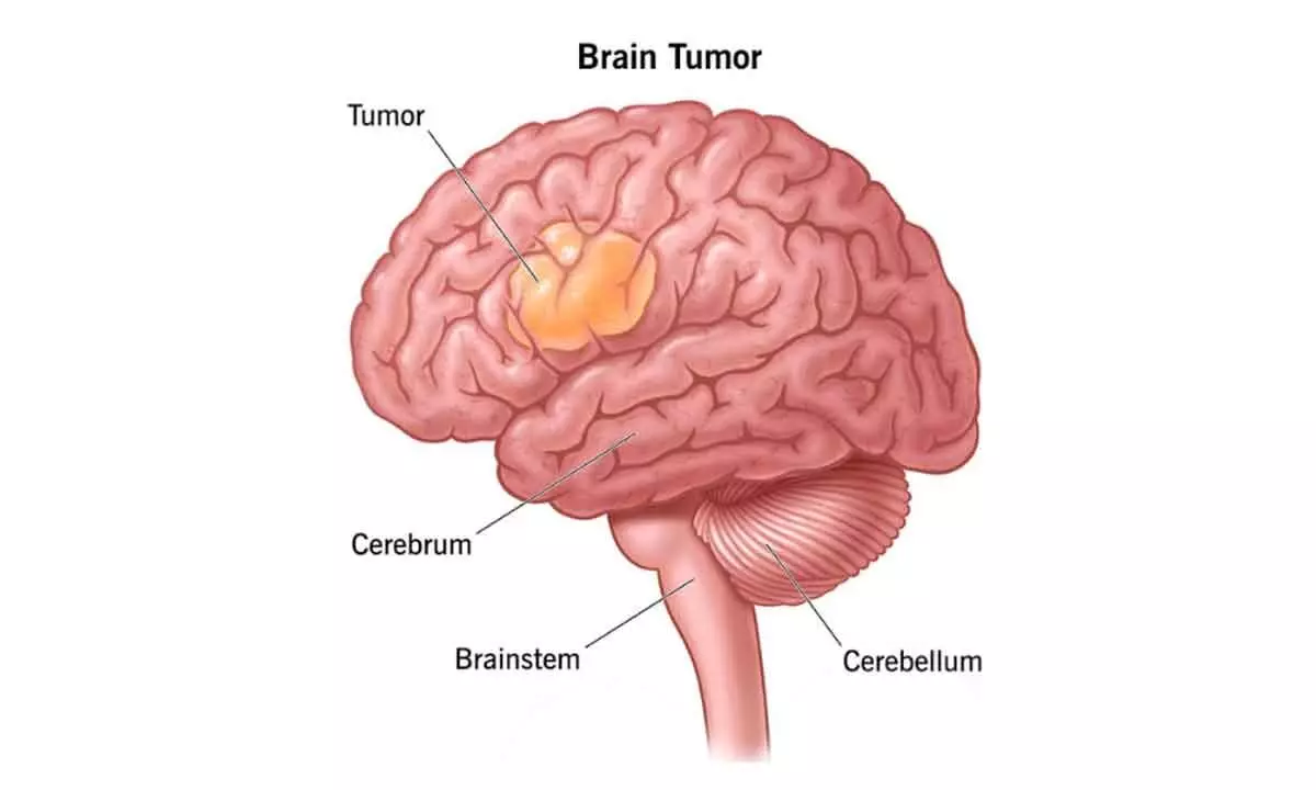 World Brain Tumor Day: Types, affects, symptoms & treatment