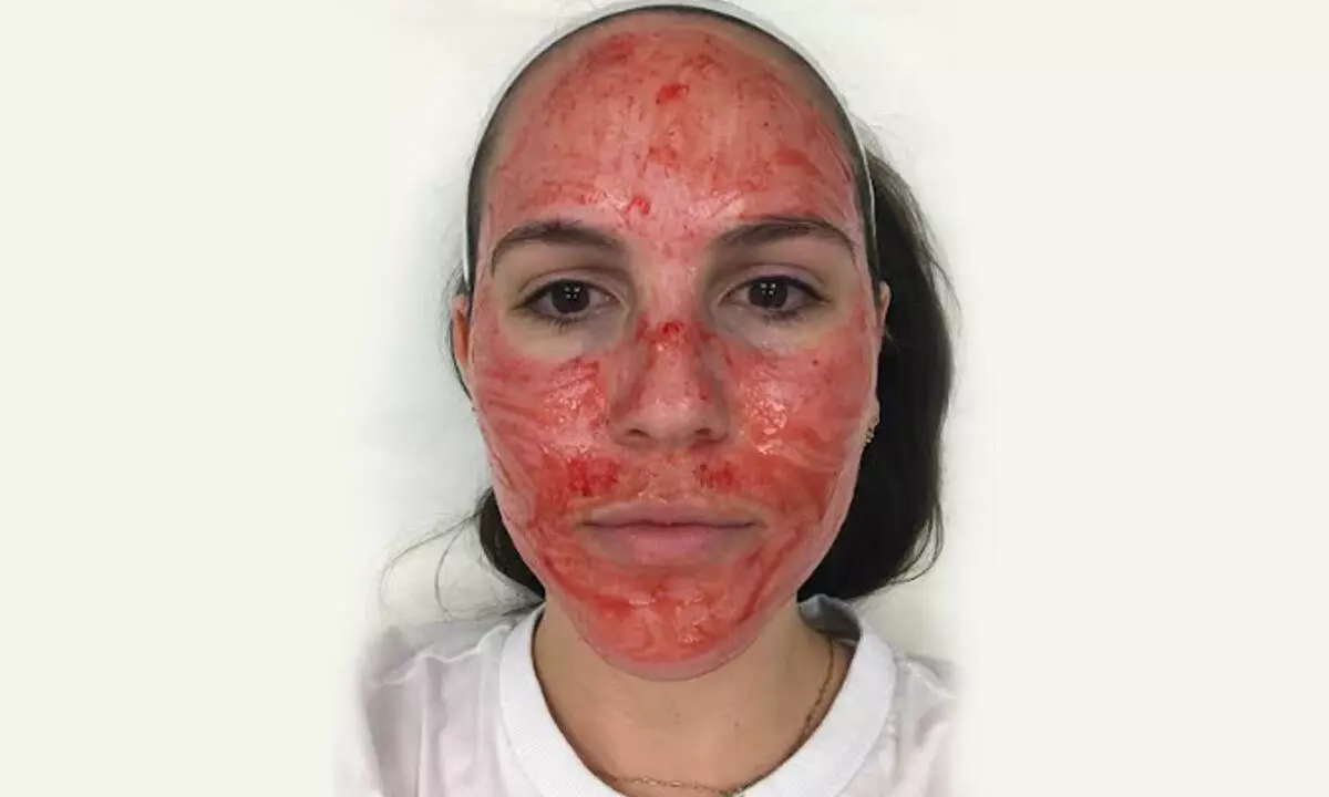 Vampire facial: The trending plasma skincare treatment