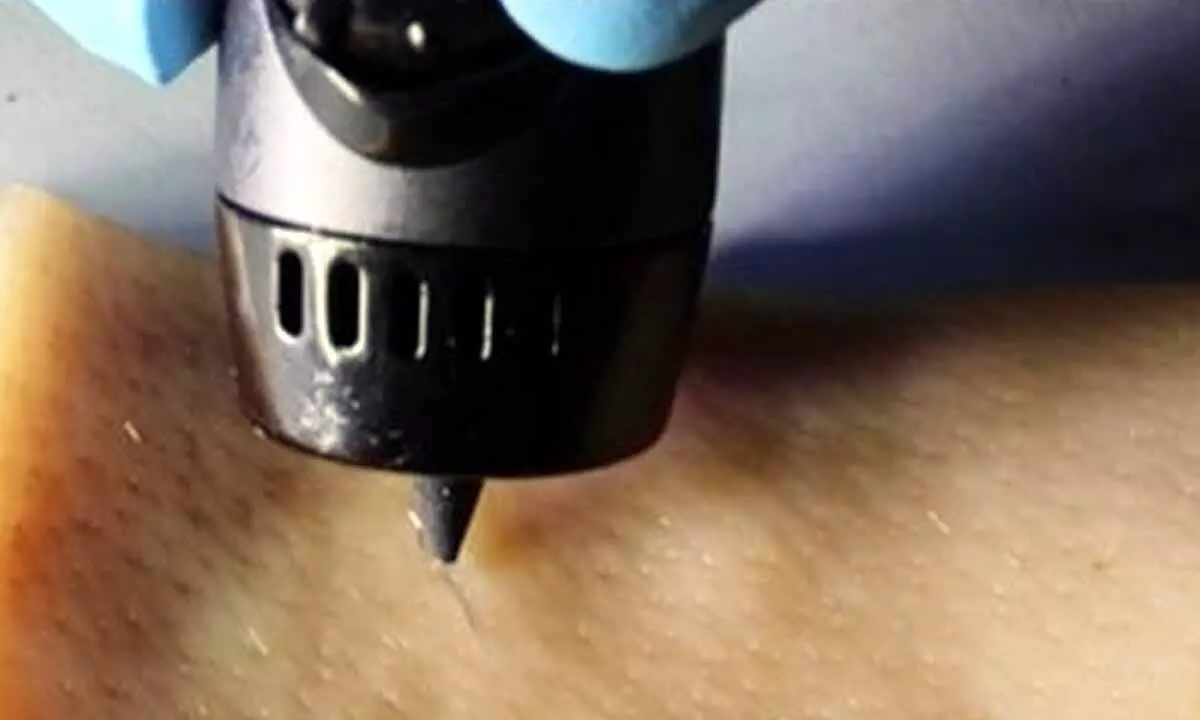 New wound-healing ink repairs cuts with a 3D-printing pen
