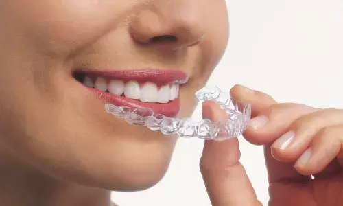 Dental implants and aligners