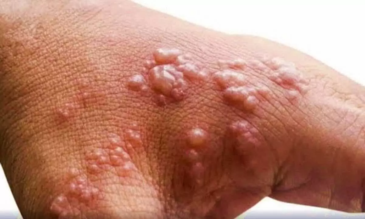 Smallpox spreads in Bihar village, locals allege medical negligence