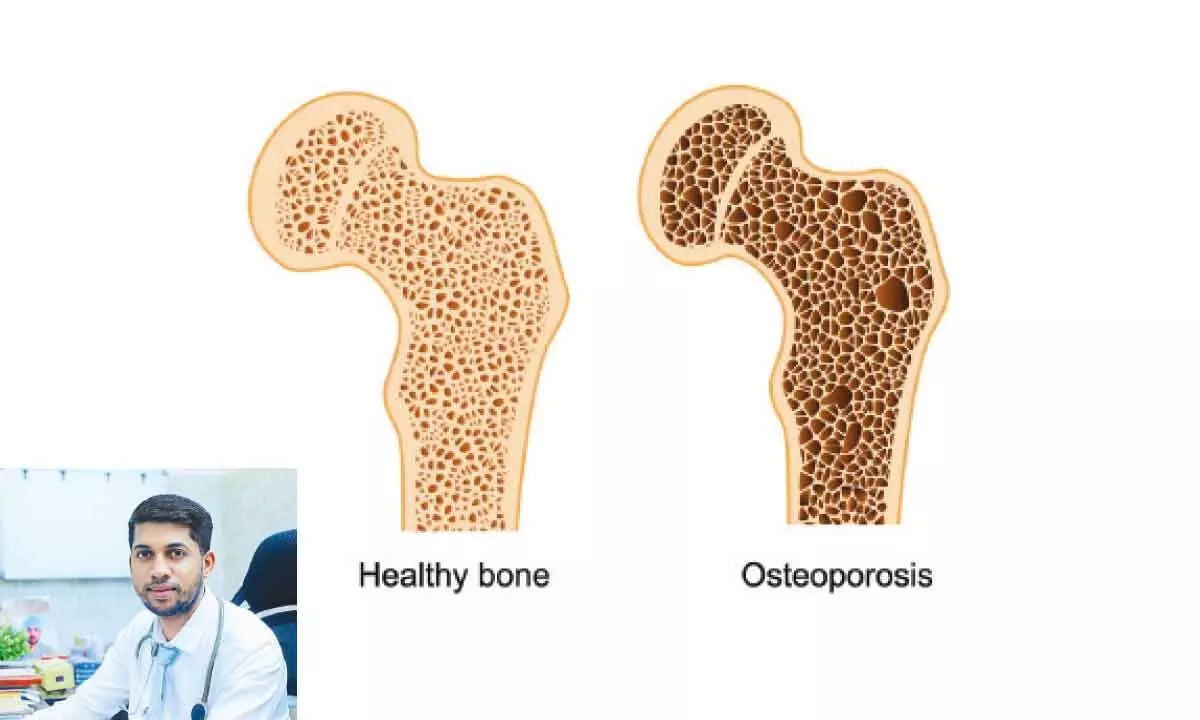 Bone Health: Diagnosis and Treatment