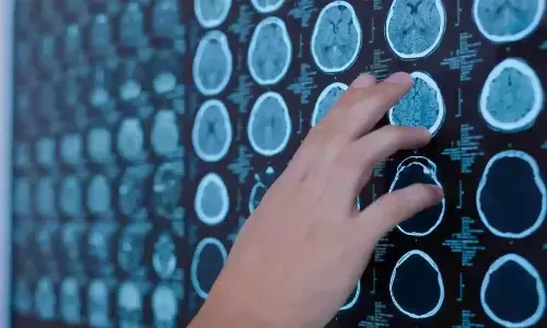 Genetics and concussion – why minor knock can be devastating for some