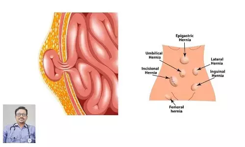 Hernia, Its Prevention and Management