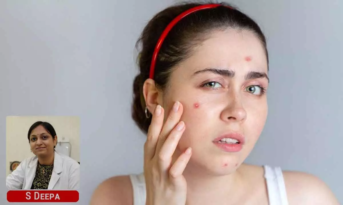 The effective way of managing acne