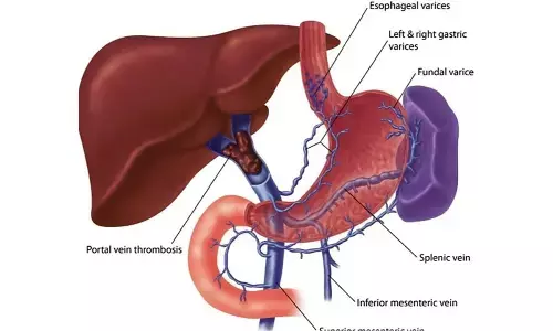 Hospital saves girl suffering from Portal Vein Thrombosis, a rare reported condition