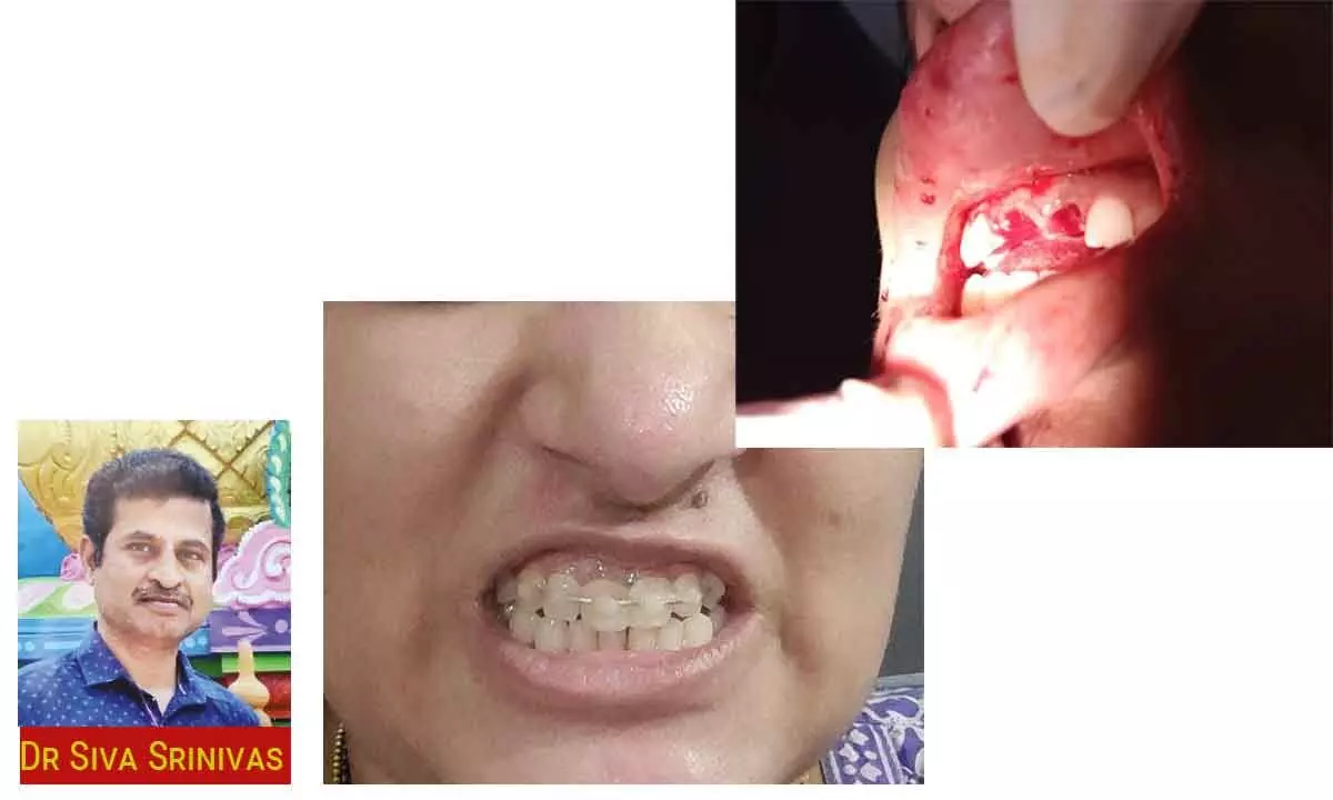 Tooth Avulsion and Replantation