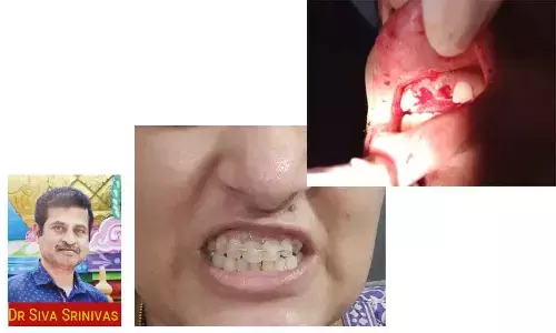 Tooth Avulsion and Replantation