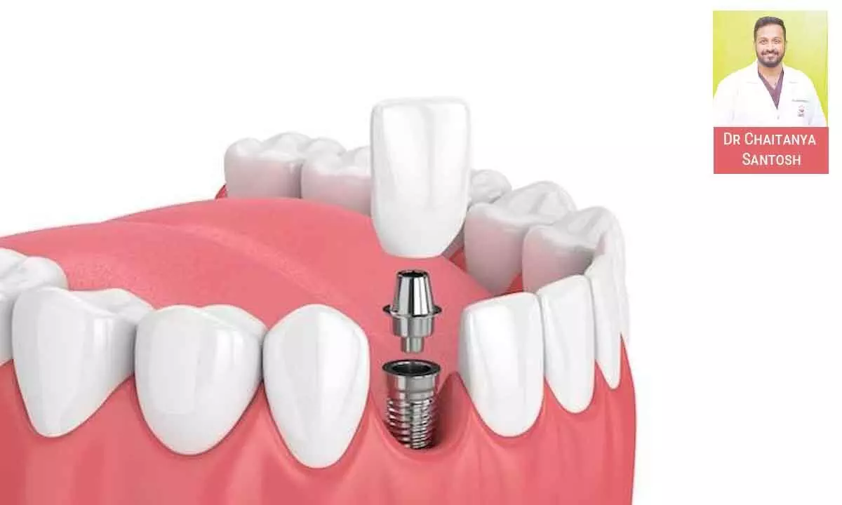 Exploring the benefits of basal implants