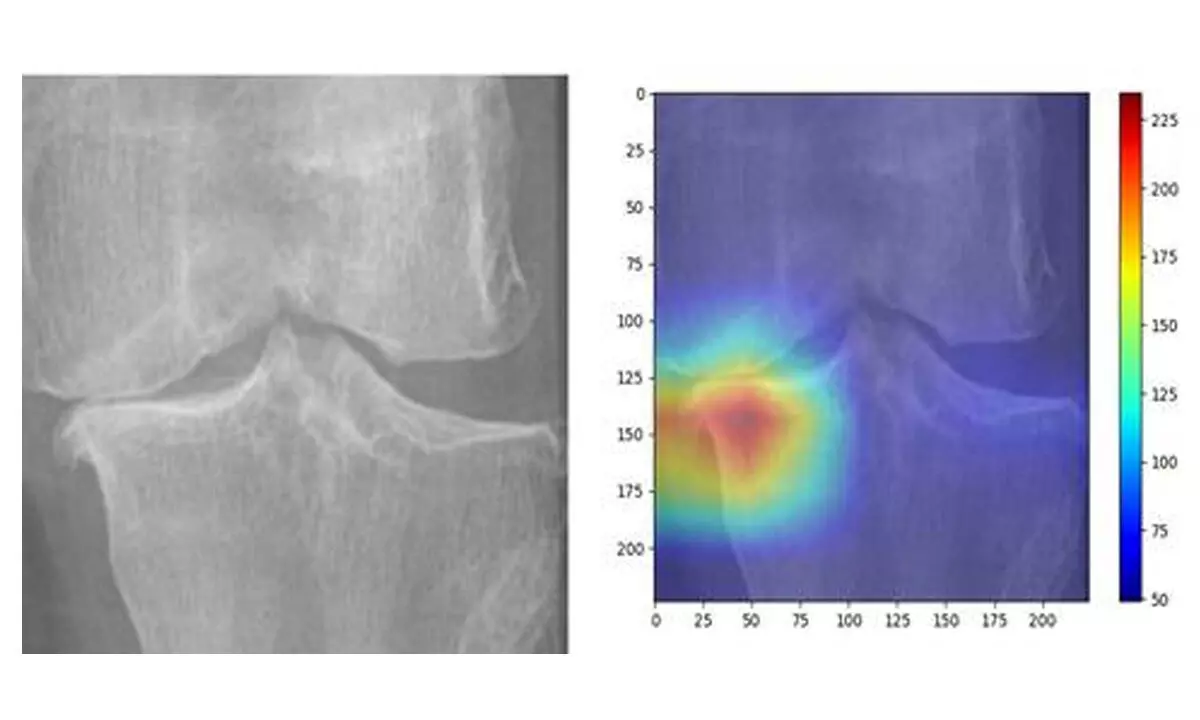 IIT Guwahatis AI model to predict knee osteoarthritis severity from X-rays