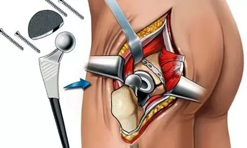Doctors seeing 30% rise in hip surgeries in young patients post pandemic