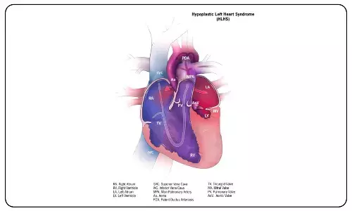 Study finds new genes that may contribute to congenital heart diseases