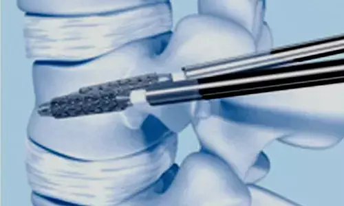 65-year-old woman undergoes vertebral body stenting in Hyderabad