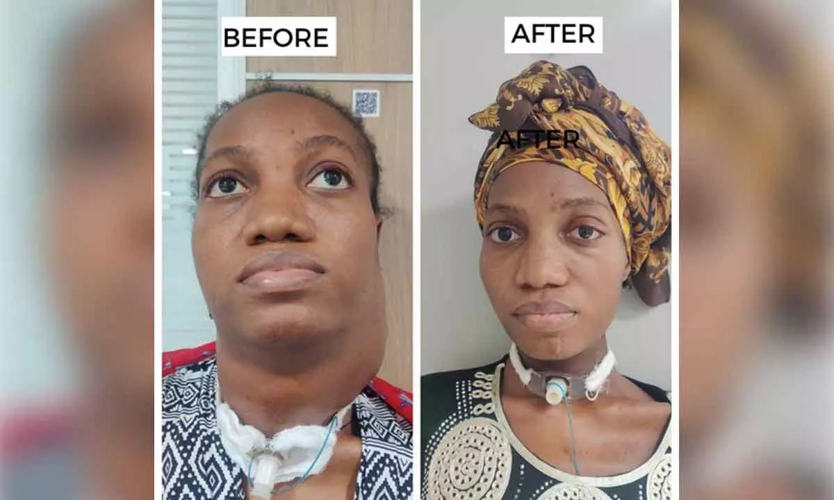Doctors remove musk melon-sized tumour from Nigerian womans neck