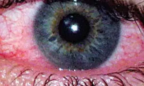 Rising cases of eye infections in schools