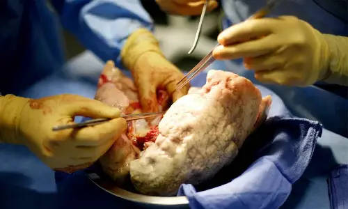 Hyderabad: NIMS doctors conducts first lung transplant surgery under Aarogyasri