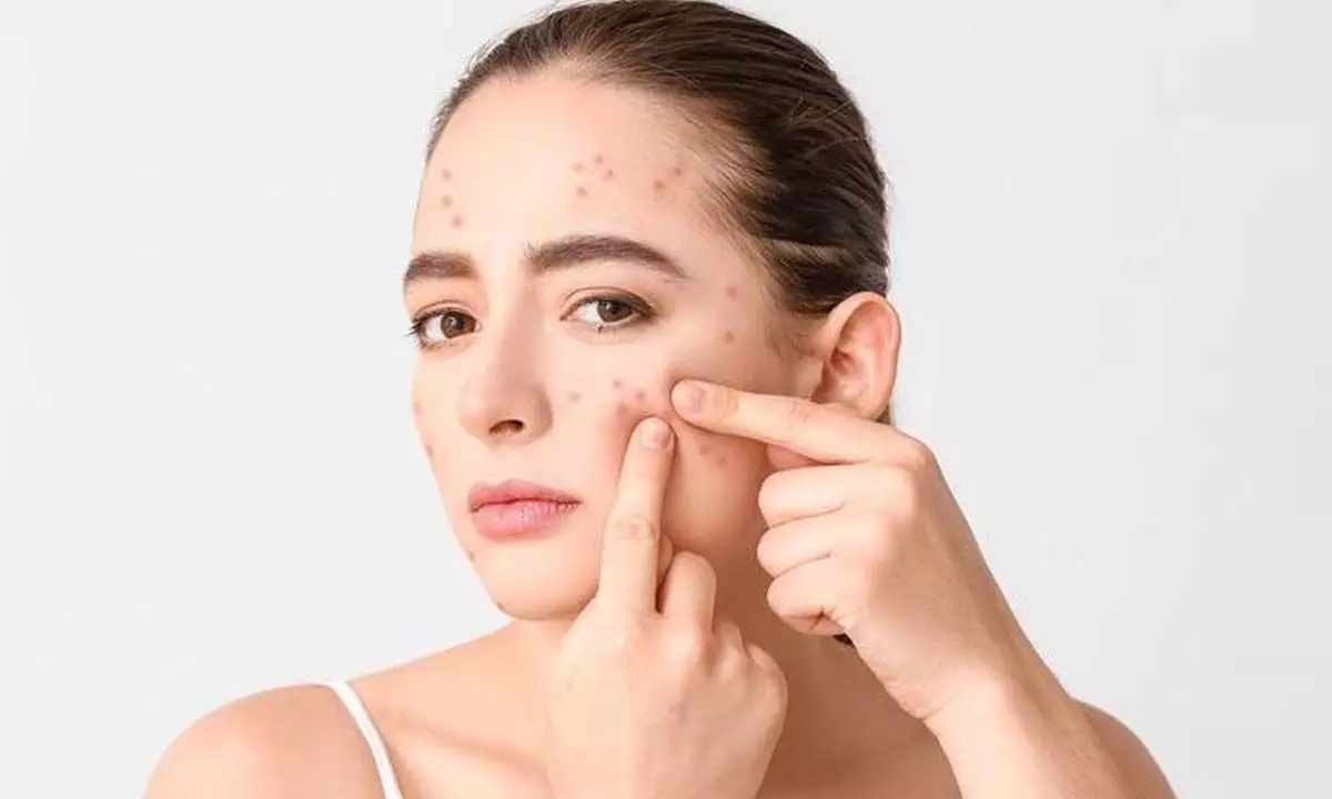 Pop these myths not your pimples!