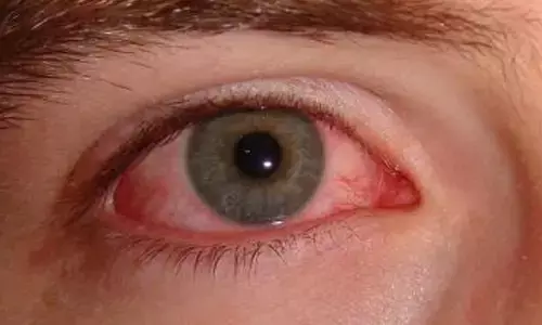 A Nationwide Upsurge in Pink Eye Conjunctivitis Cases, especially Follicular Conjunctivitis