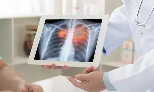 World Lung Cancer Day 2023 Date, History & Significance