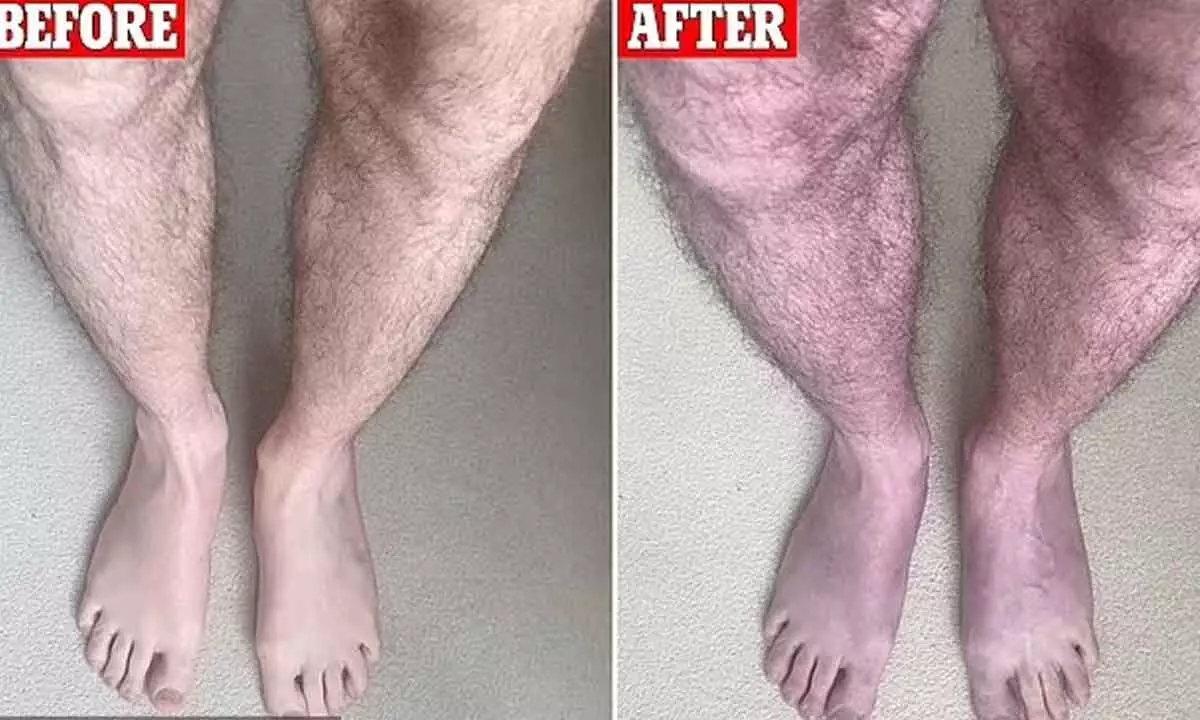 Long Covid patients legs turned blue in just 10-min of standing