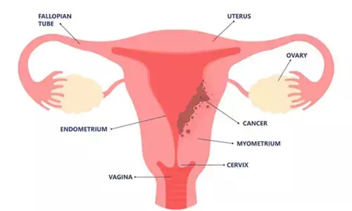 Testosterone shows promise to treat endometrial cancer: Study