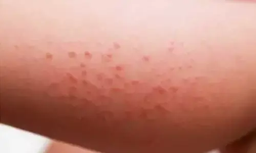 Childhood allergies skin, lungs begin in our gut: Study