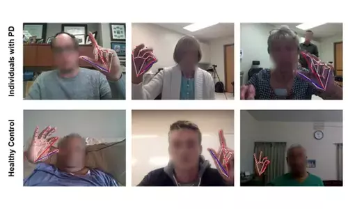 Online AI-based test for Parkinsons severity shows promising results