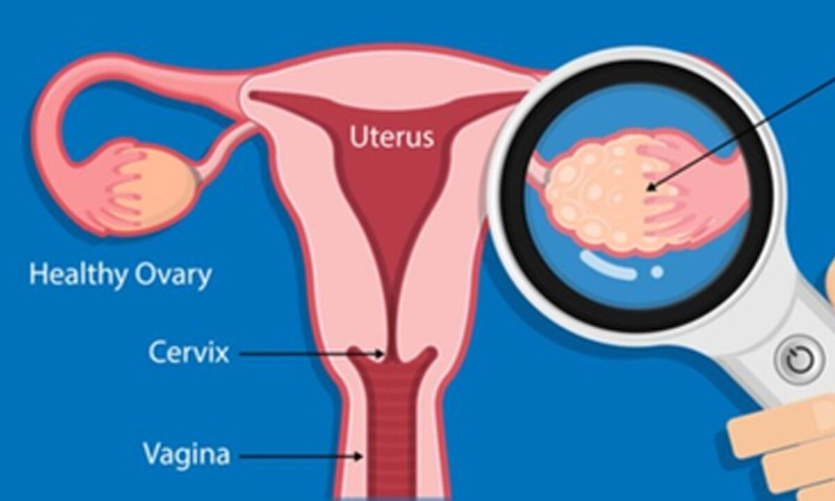 Stem cell-derived components may help treat PCOS