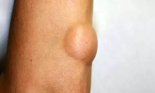 Dont ignore painless lumps in body: experts