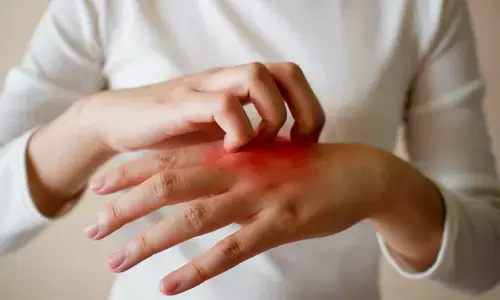 Skin disease can raise risk of inflammatory bowel disease: Study