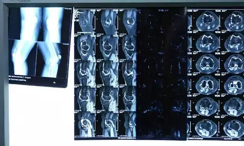 Knee Surgery for Mere 67 Rupees Under Ayushman Bharat Arogya Karnataka Yojana