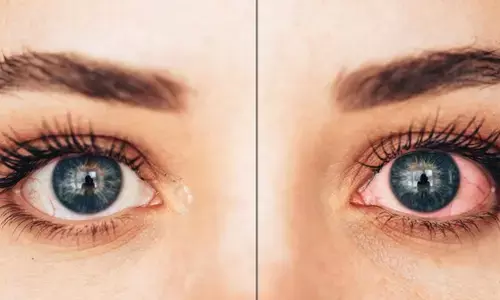 Pink eye disease to spread round the year due to climate change