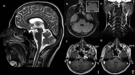 Leprosy impacts brain, spinal cord: KGMU study