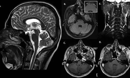 Leprosy impacts brain, spinal cord: KGMU study