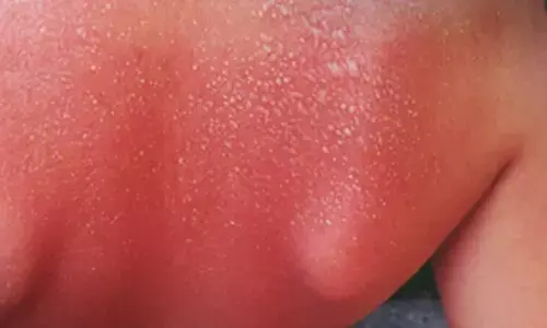 New super melanin cream to heal your skin from chemical, sunburn